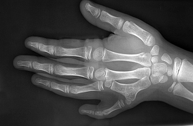 Metacarpal Synostosis Hand Surgery Resource 3679